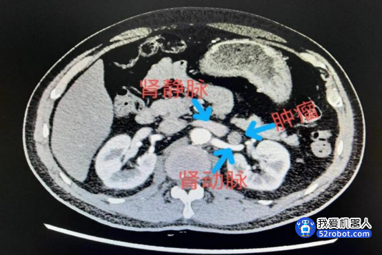 医院借助达芬奇手术机器人 完成高难度肿瘤切除术