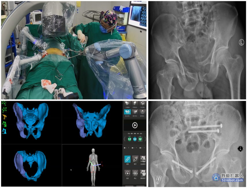 骨科手术机器人远程诊疗，使骨折治疗不再受地域限制