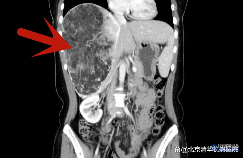 清华长庚医院用手术机器人切除21厘米肝脏肿瘤 达成患者小创口心愿