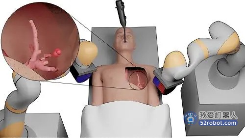 微型手术机器人或改变肺癌诊疗方式